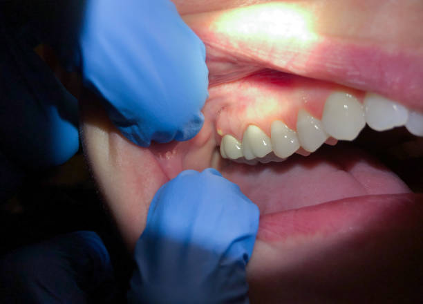 Best Urgent Care for Lost Fillings or Crowns in Hampstead, MD